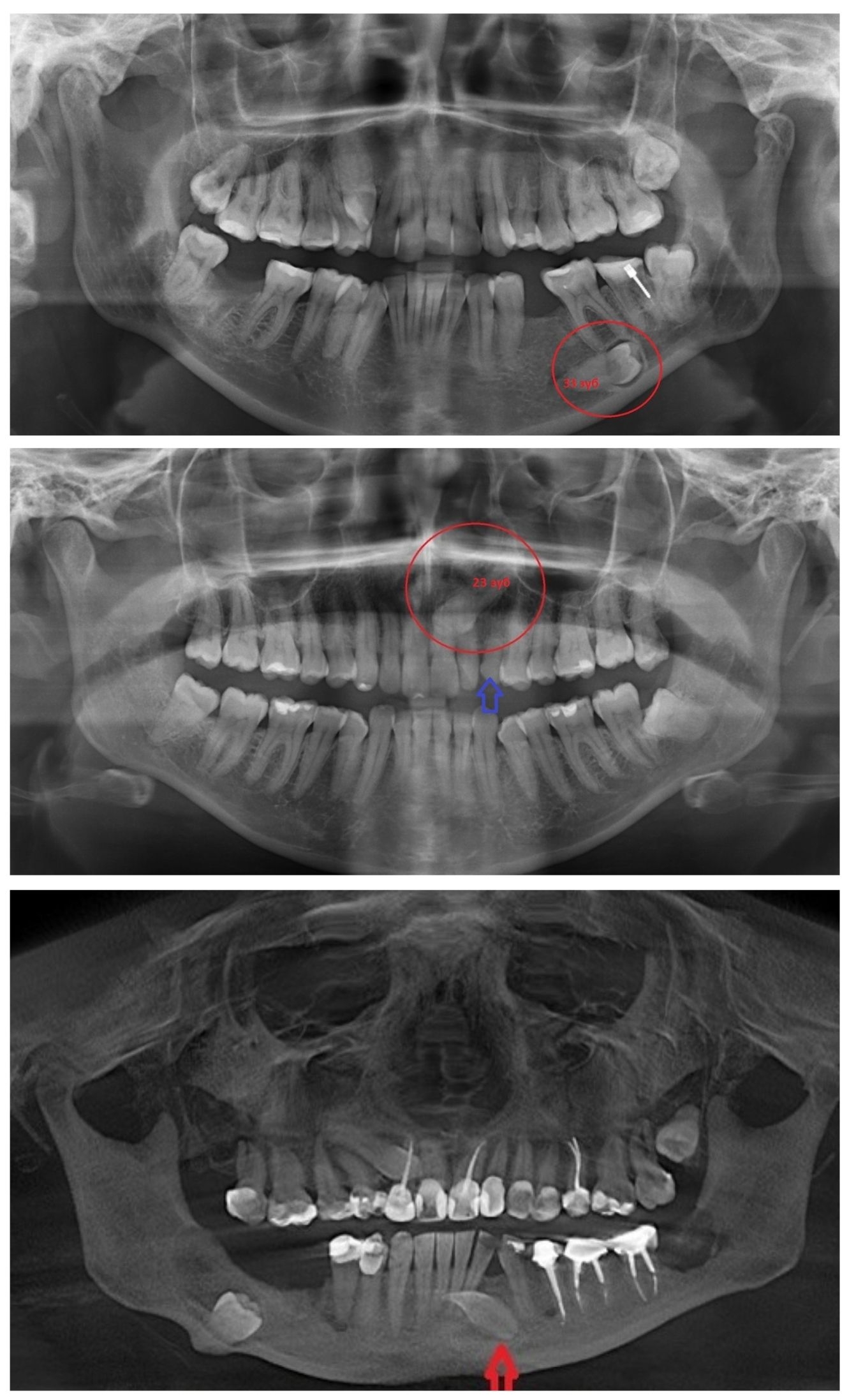 Примеры ретинированных зубов на рентгеновском снимке