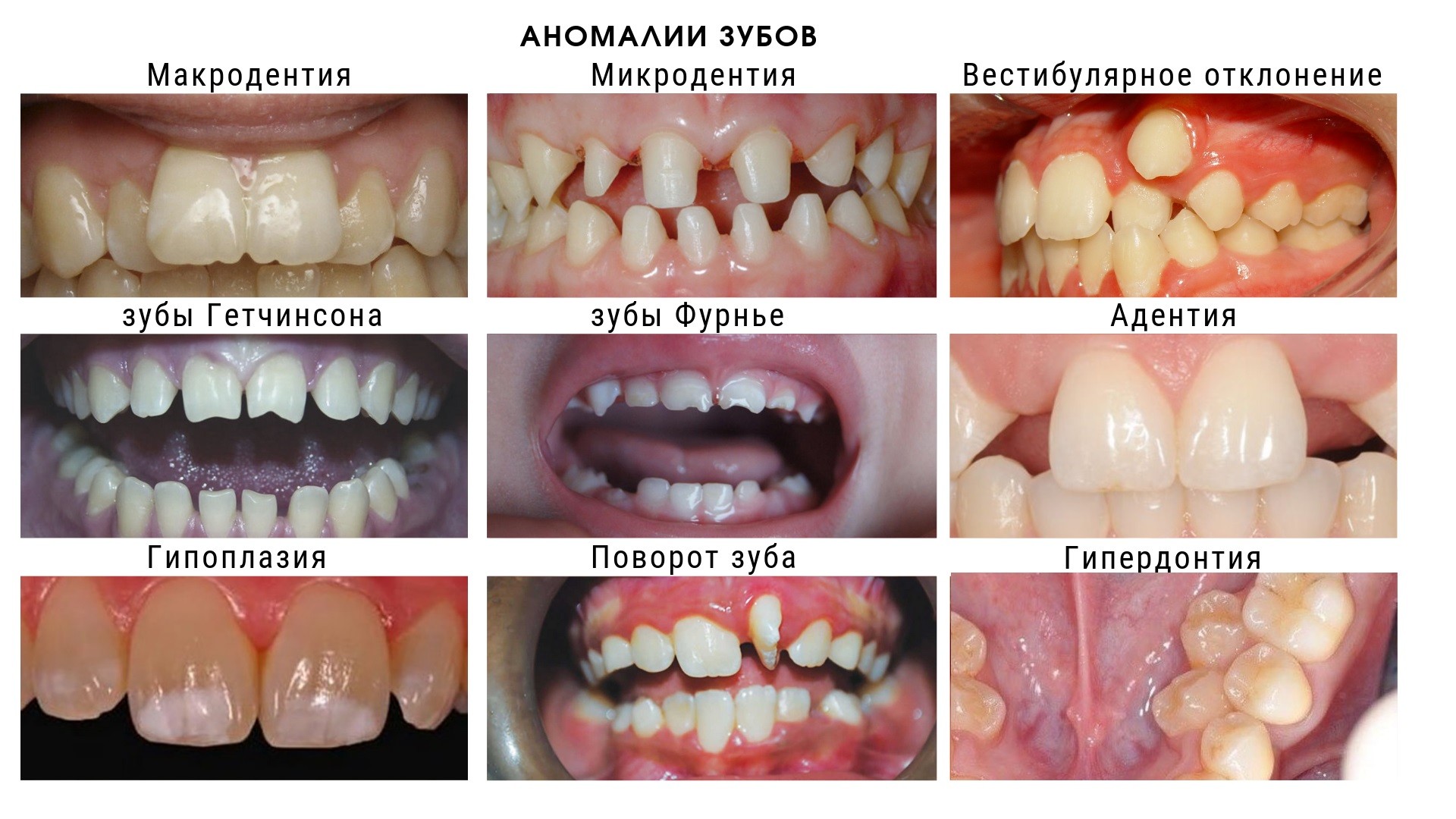Наиболее частые виды аномалии зубов