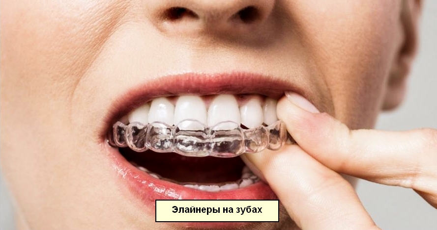 Прозрачные капы на зубах