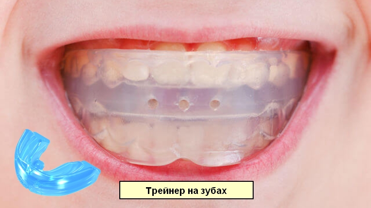 Изображение трейнера отдельно и он же на зубах пациентки