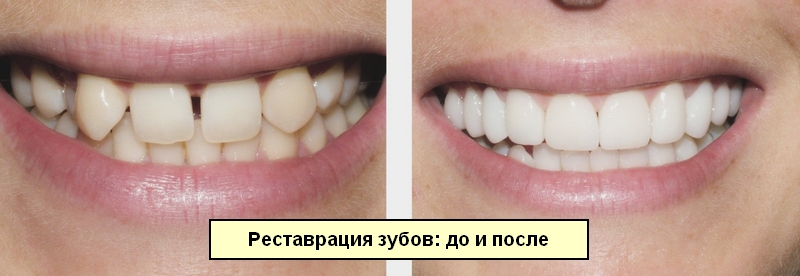 Зубы до и после реставрации и лечения