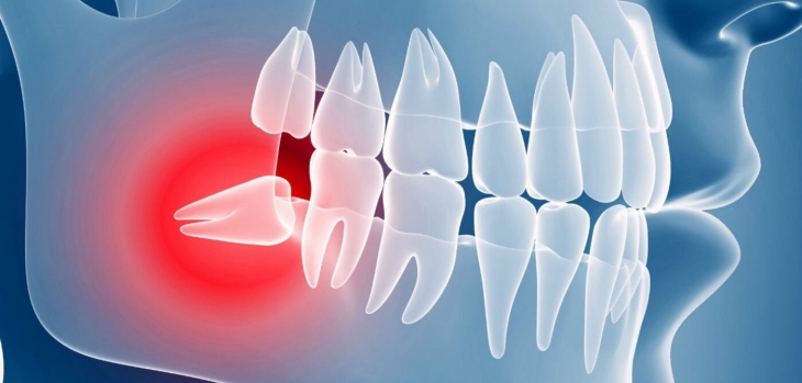 Удаление ретированного зуба что значит