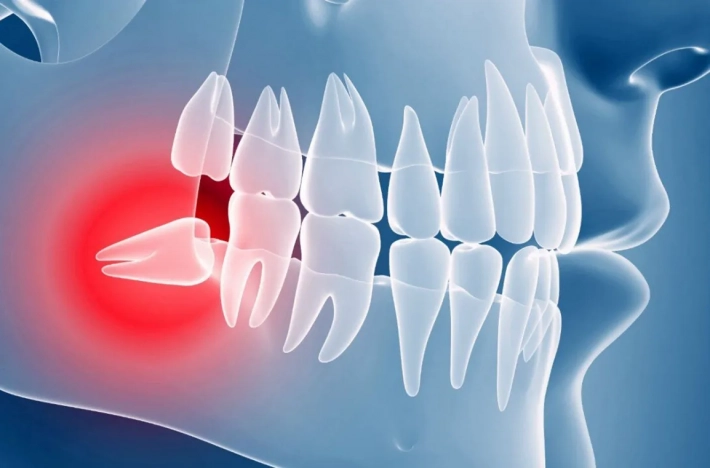 Что такое ретинированные зубы, отчего они появляются и как их лечить