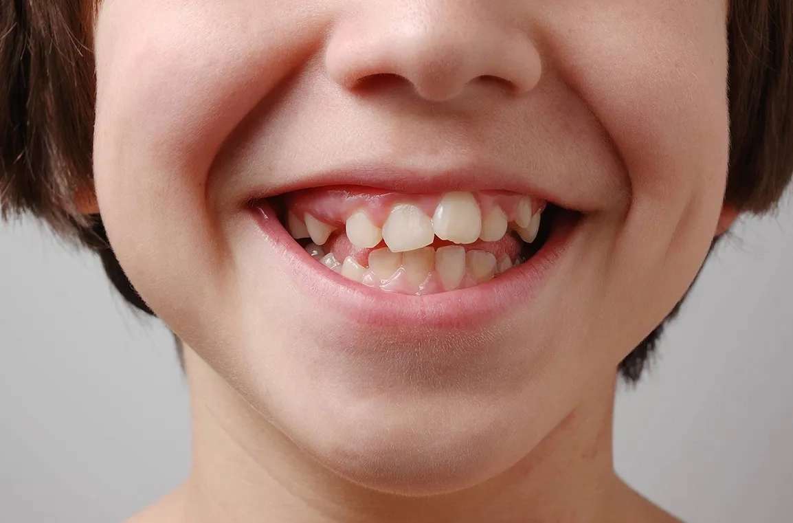Кривые зубы — что делать, и кто виноват