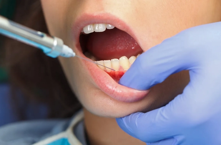 Исследователи выявили главные аллергены в стоматологии