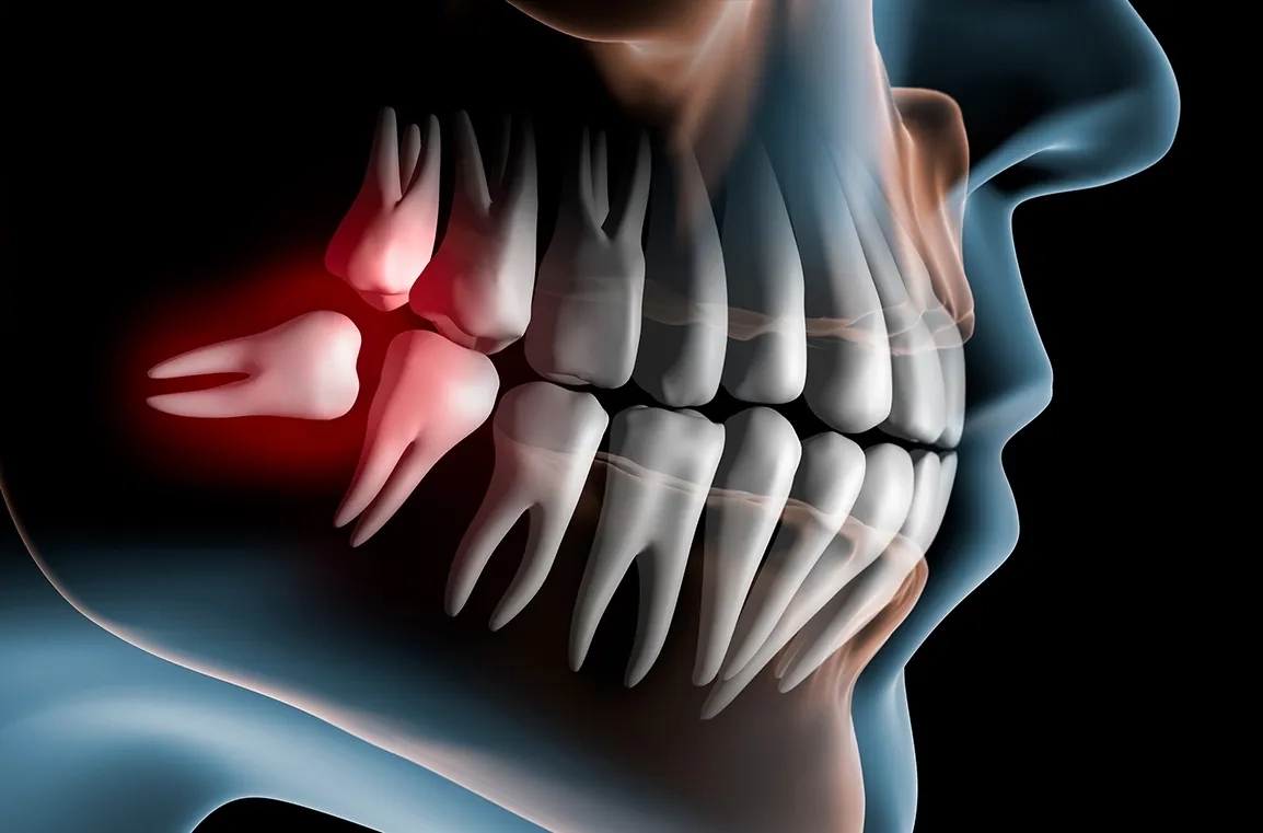 Дистопированные зубы: их опасность, особенности, как это лечат