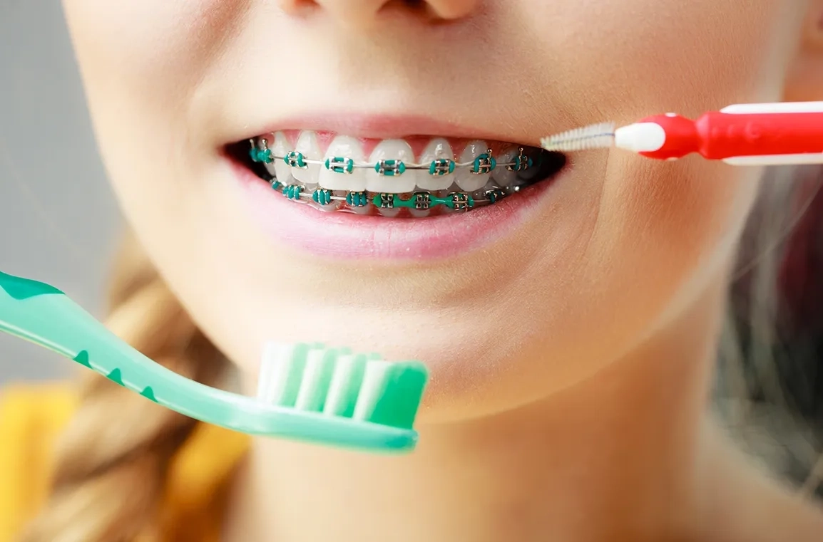 Какие зубные щетки нужны для ухода за брекетами?
