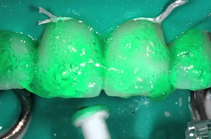 ICON – медикаментозное лечение кариеса на ранних стадиях