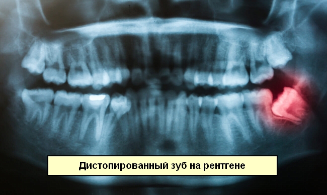 distopirovannyj zub na rentgene