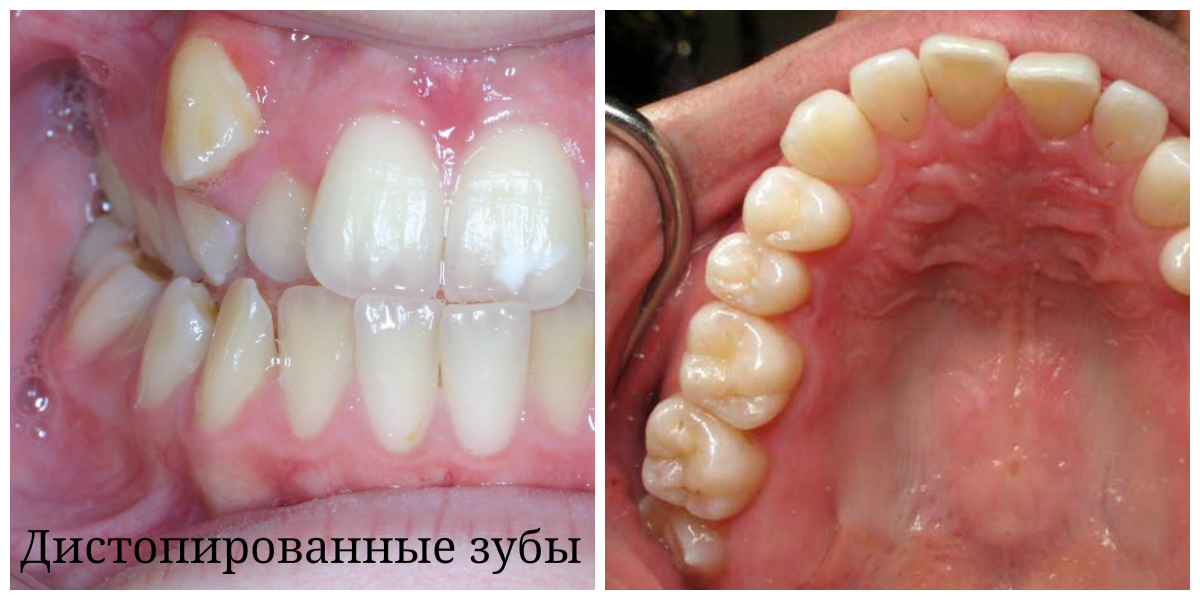 Два примера дистопии зубов
