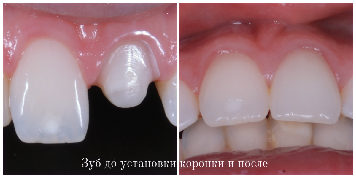 Зуб до и после установки коронки