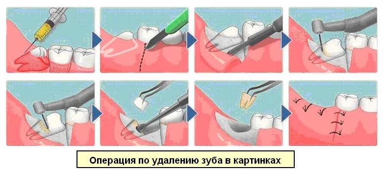 Удаление дистопированного зуба в картинках